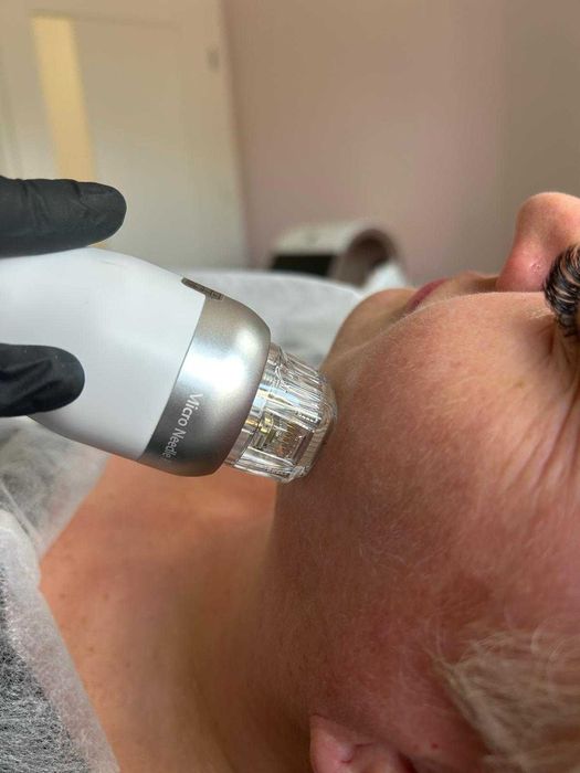 Wynajem urządzenia Radiofrekwencja mikroigłowa - RF frakcyjny