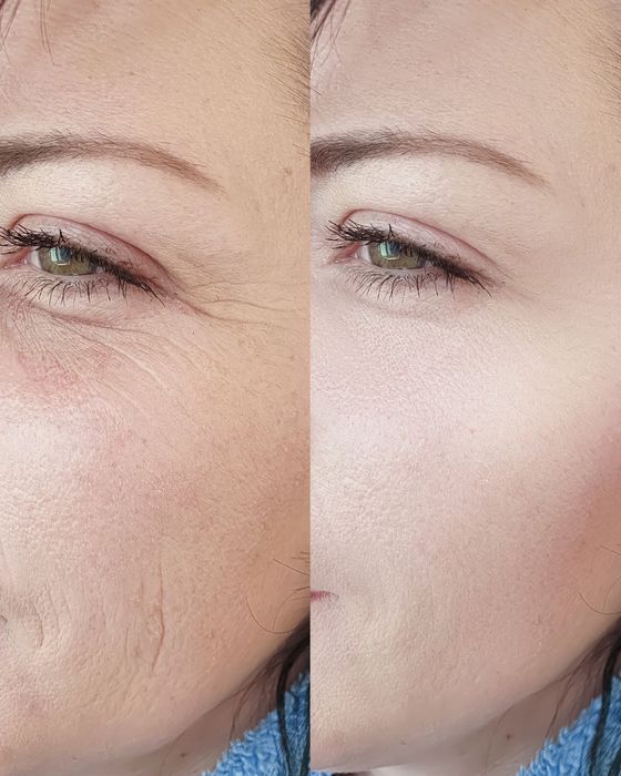 Stymulatory tkankowe pod oczy – redukcja zmarszczek i napięcie skóry