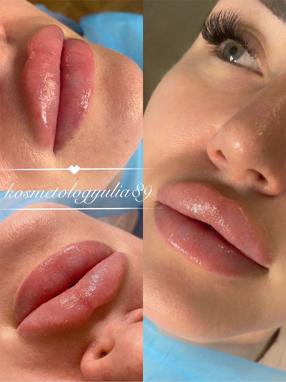 Увеличение губ от 2300 грн Sardenya Deep