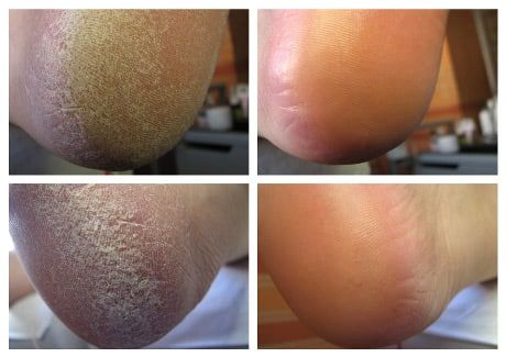 Каллус ремувер Гель для кислотного педикюра Callus Remover (США)