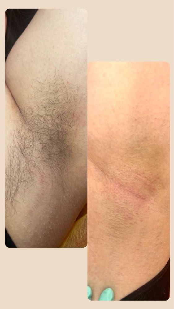 Электроэпиляция, поселок Котовского