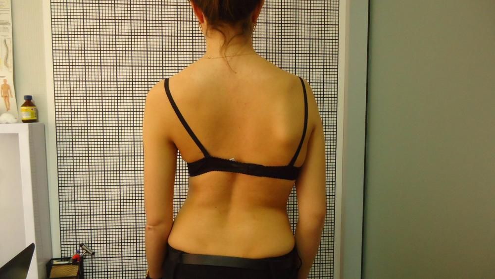 Гарантоване лікування сколіозу у дітей і дорослих