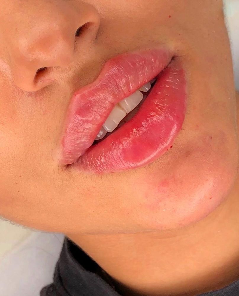 Powoekszanoe ust Russian Lips 1ml 600zl ,botox , volumetria twarzy