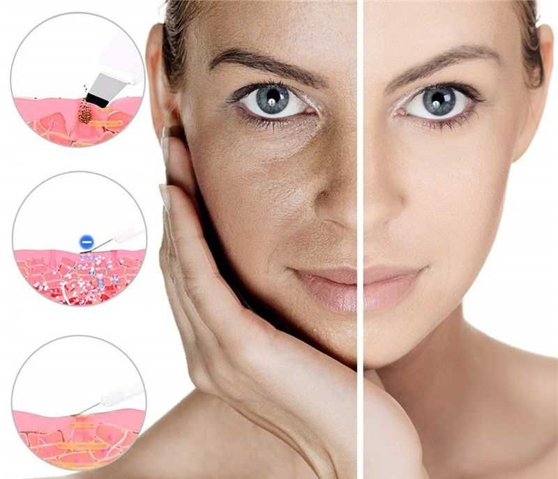 Ultradźwiękowy Peeling Kawitacyjny Delikatne Oczyszczanie Skóry Twarzy