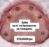 зуби на 6-ти імплантах за тиждень