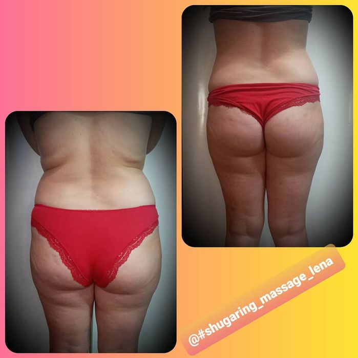 Масаж вакумний(апаратний) Антицел-тний; Шугаринг;Титова.