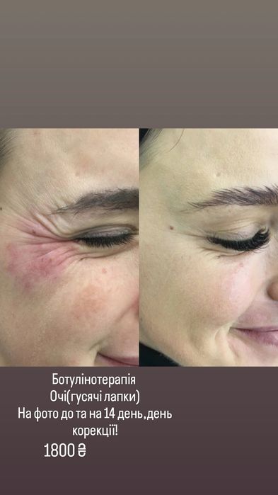 Ботулінотерапія,botox