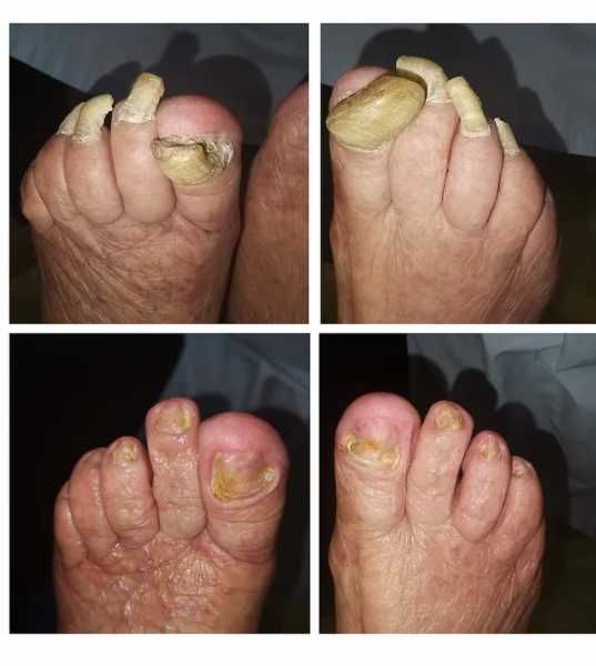 Подолог с Выездом на Дом для стариков,вросший ноготь,грибок,Медпедикюр