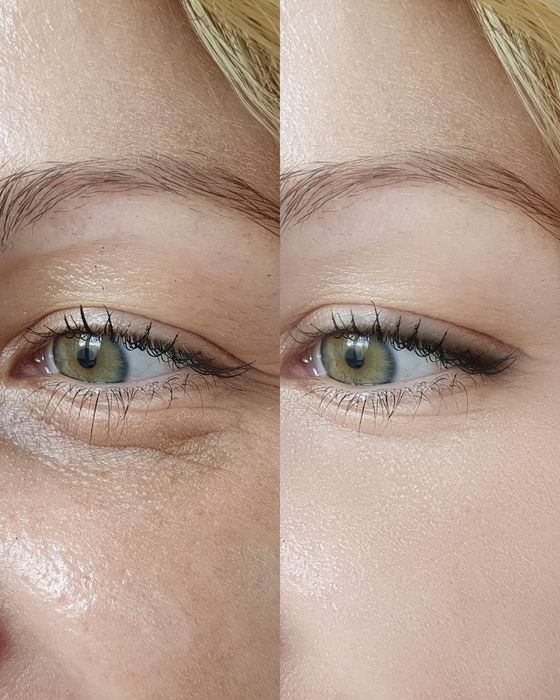 Stymulatory tkankowe pod oczy – redukcja zmarszczek i napięcie skóry