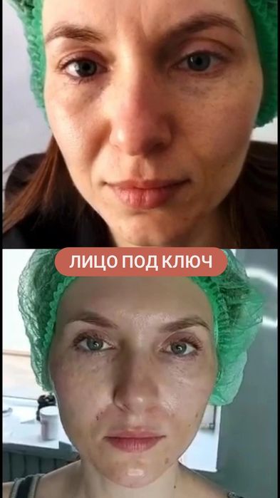 Ботокс. Коррекция морщин,всё зоны, Фулфейс.