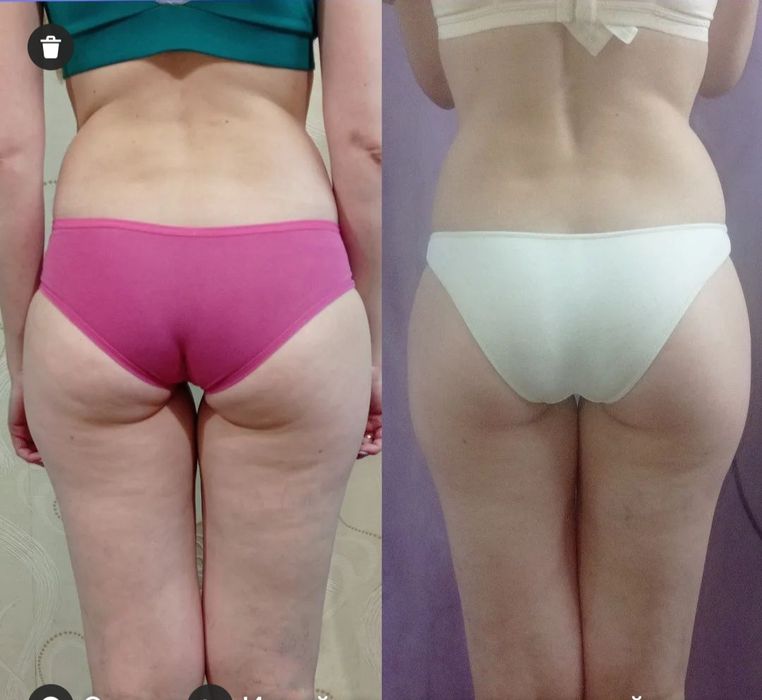 Масаж вакумний(апаратний) Антицел-тний; Шугаринг;Титова.