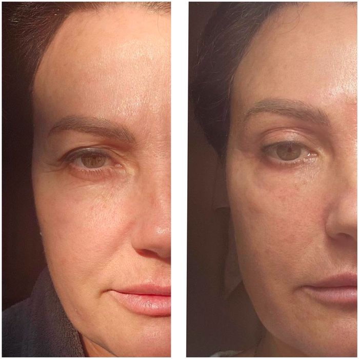 Холодна плазма НОВА розробка вчених Косметологічний апарат