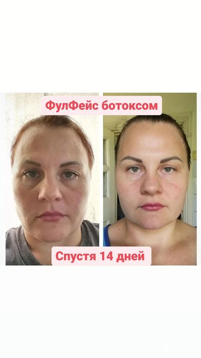 Ботокс. Коррекция морщин,всё зоны, Фулфейс.