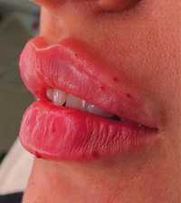 Powiększanie  ust Russian Lips 1ml 600zl ,botox , volumetria twarzy