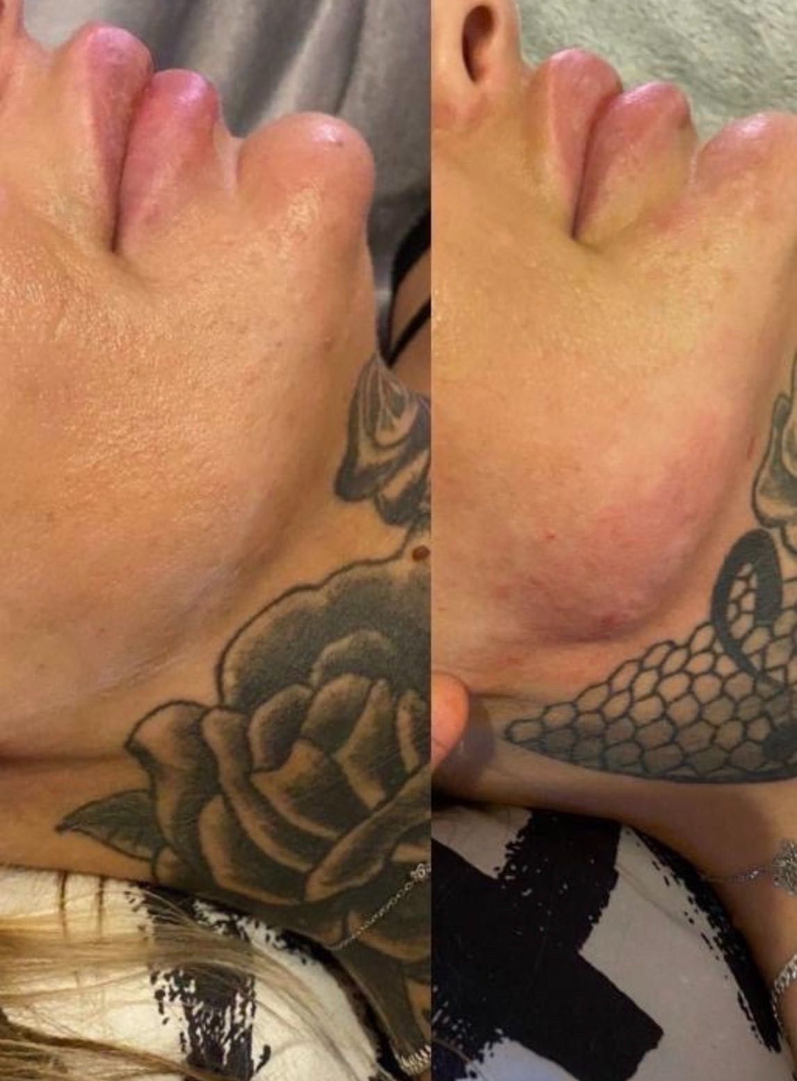 Powiększanie usta RUSSIAN LIPS , NA PLASKO 1ml 600zl, botox