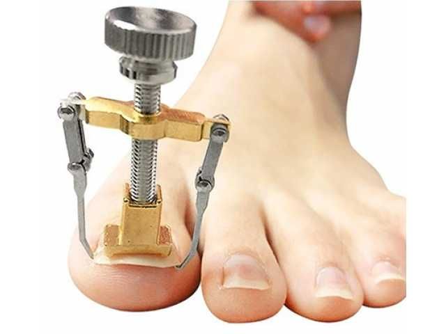 KLAMRA Korekcyjna Przyrząd na WRASTAJĄCE PAZNOKCIE do Stóp Metalowa