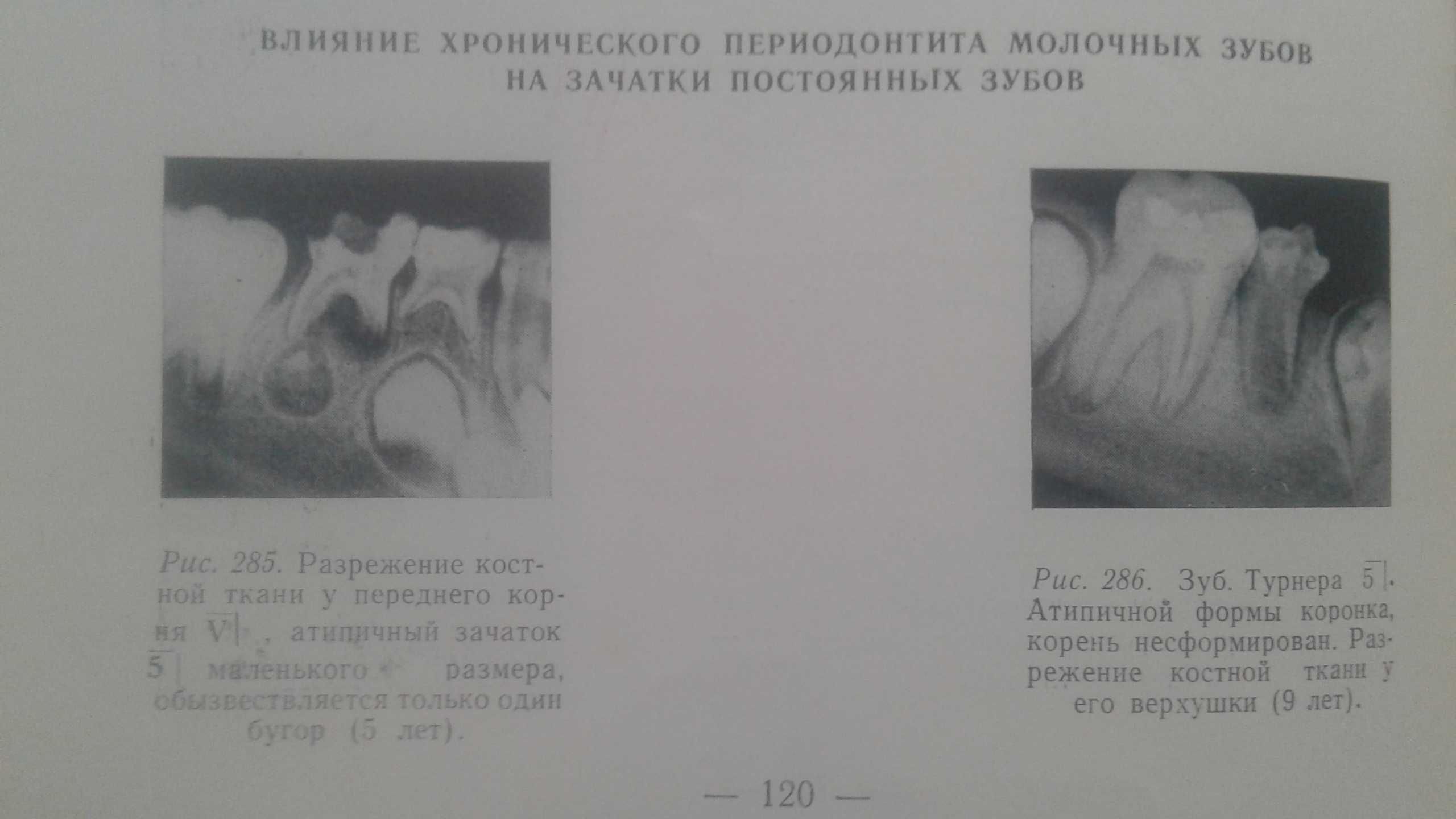 Атлас рентгенограмм зубов в норме и патологии у детей Стоматология