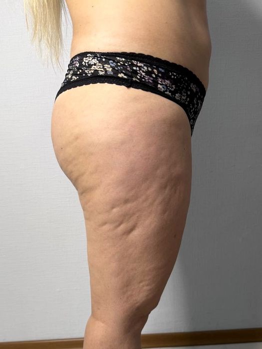 Антицелюлітний масаж