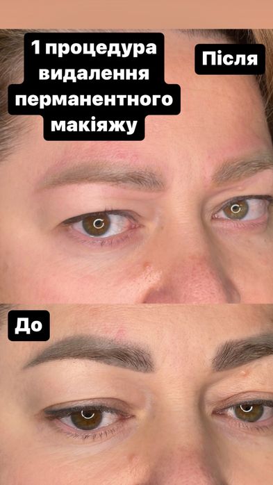 Видалення тату і перманентного макіяжу будь якої складності від 500грн