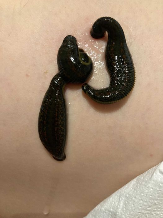 pijawki - stawianie pijawek z dojazdem do pacjenta Łódź