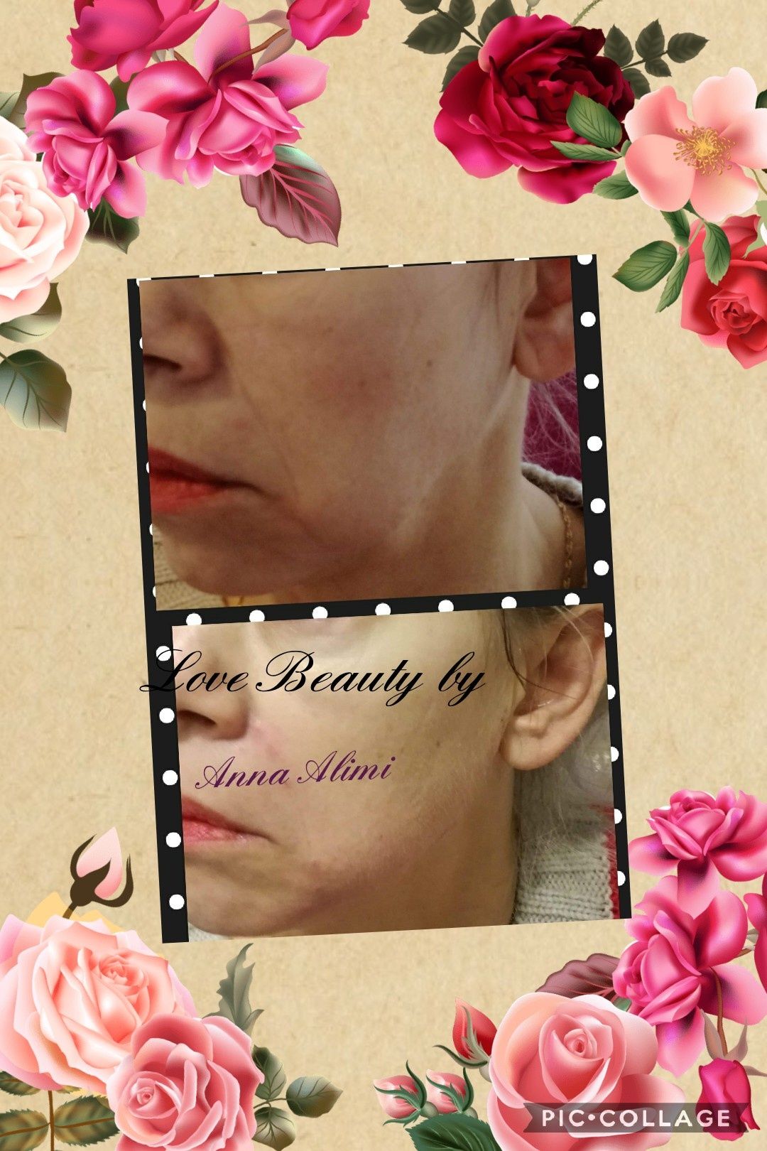 PROMOCJA botox powiększanie ust hialuronowy laser HIFU