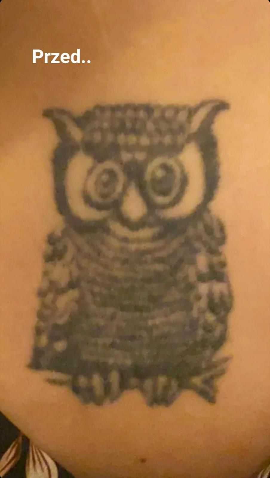 Pro laser NS+ do usuwania makijażu permanentnego tatuażu przebarwień