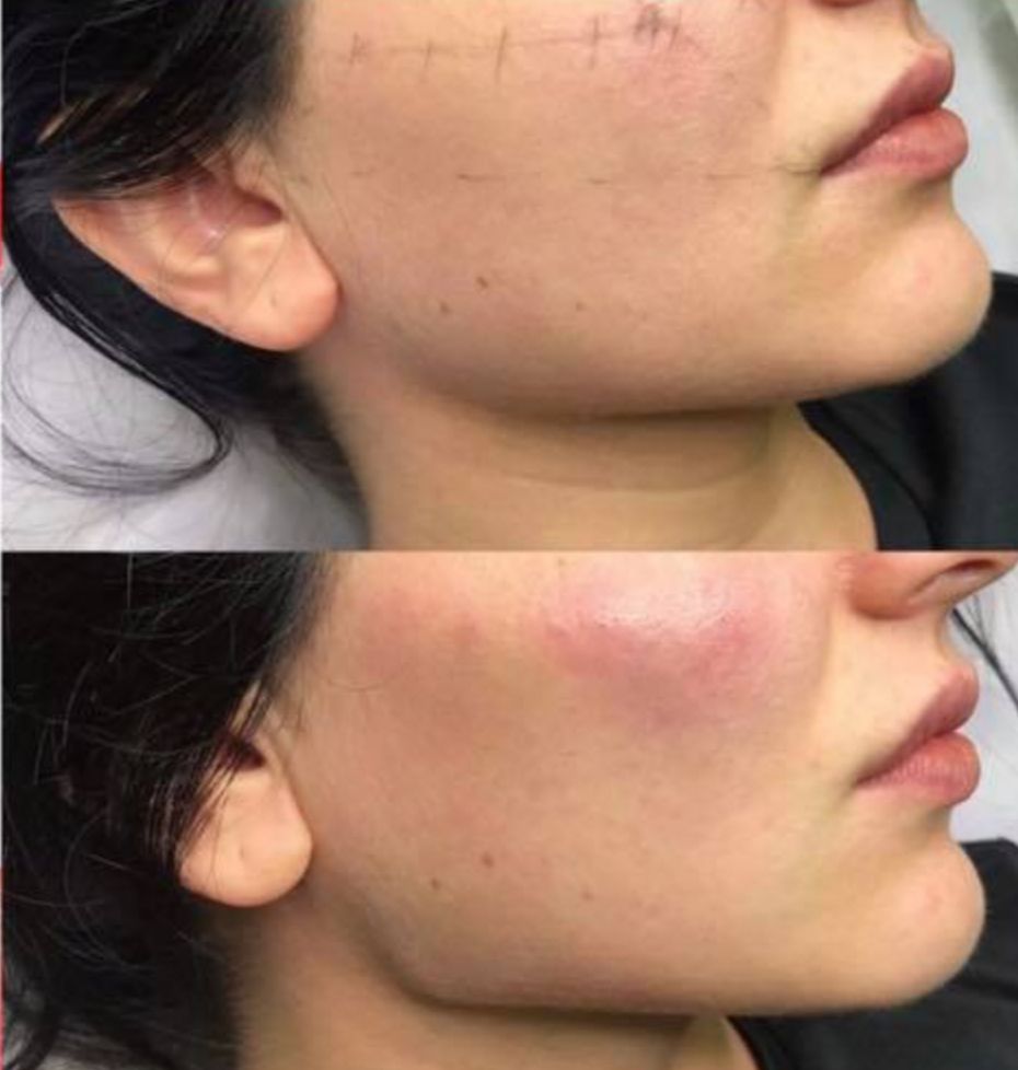 "Profil Jolie"Niechirurgiczna liposukcja twarzy Lifting ,Kąty Żuchwy