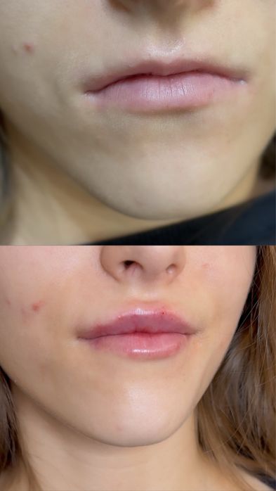 Ботокс.Увеличение губ.Гипергидроз