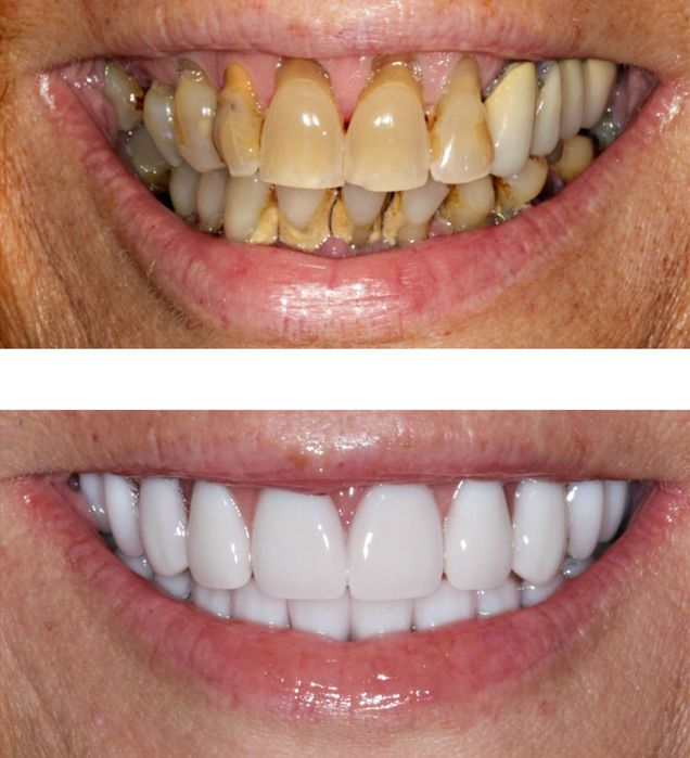 Sorriso brilhante e confiante sem dor de ouvido