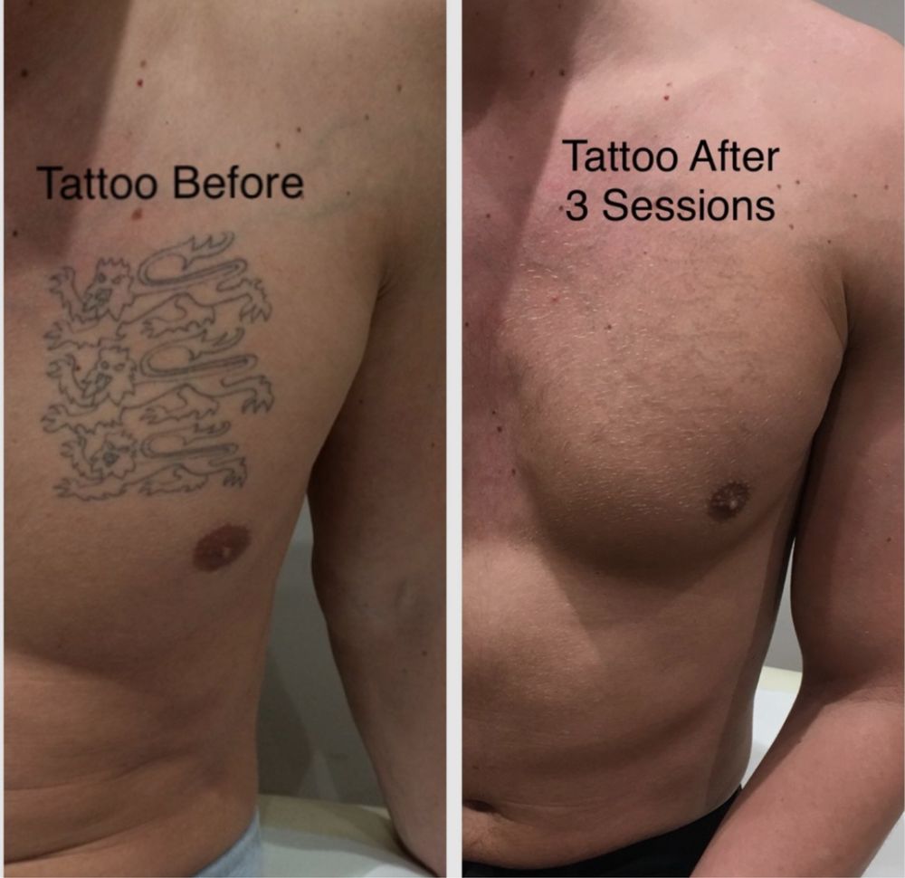 Tecnica de remocao de tatuagem, branqueamento intimo e peeling