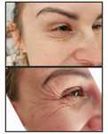 Promocja! Botox promocja 3 okolice 390zł do końca lipca!