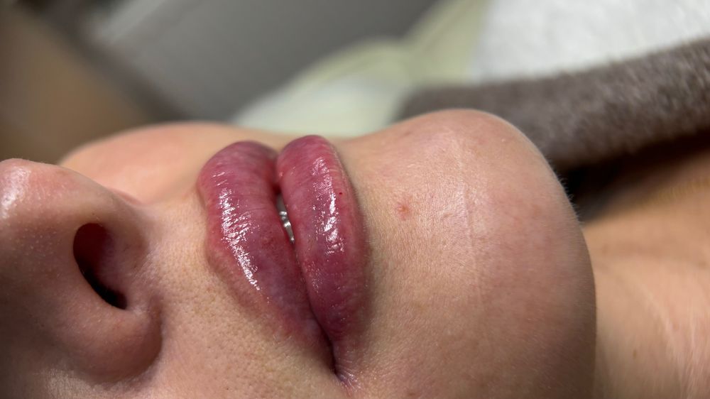 Безкоштовно збільшення губ / контурна пластика губ / ботокс