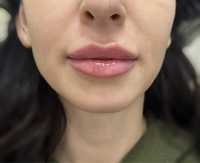 Модели на контурную пластику губ,увеличение губ.