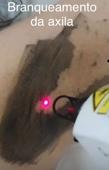 Tecnica de remocao de tatuagem, branqueamento intimo e peeling