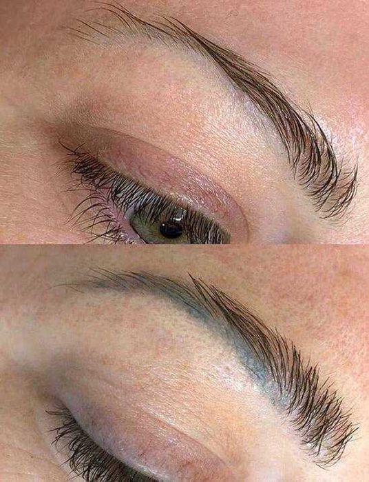 Безпечне видалення тату/татуажу, корекція шрамів