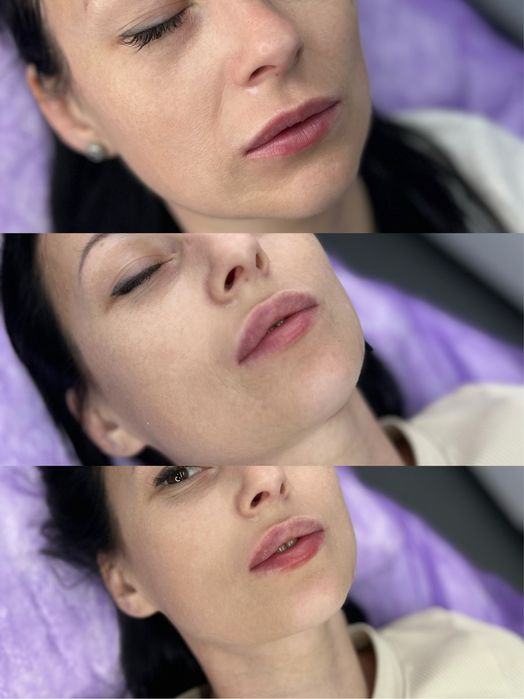 Акція. Контурна пластика губ. Запоріжжя