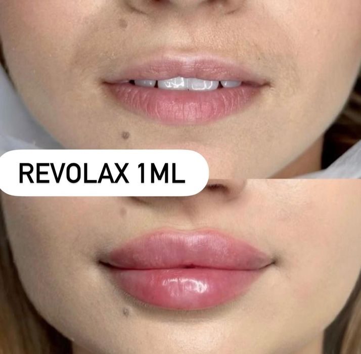 Акція збільшення губ  -2500 грн