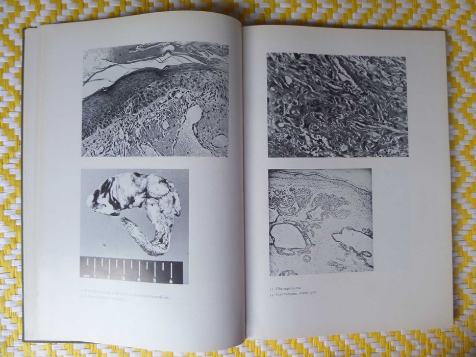 Atlas of the Histopathology of Ear Tumours
P.G. Gerlings