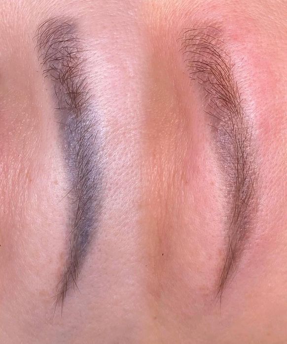 Безпечне видалення тату/татуажу, корекція шрамів