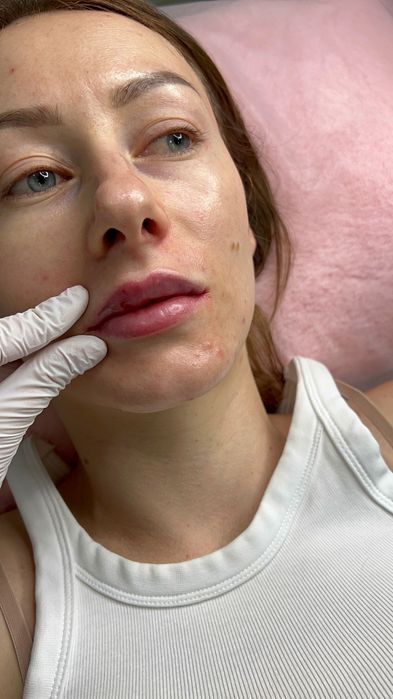 Збільшення губ / моделювання губ