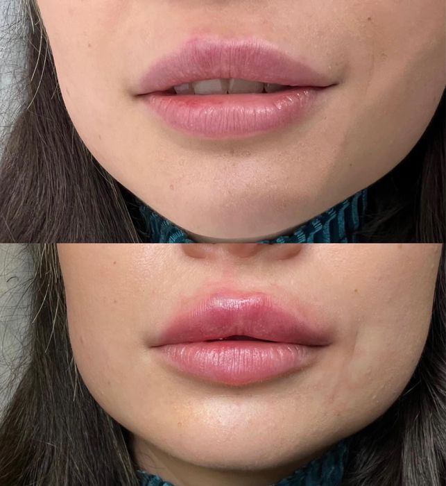 Super Promocja 450zł Modelowanie powiększanie ust wyrównanie asymetrii