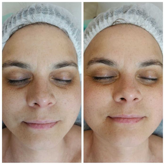 Опытный косметолог | Чистки, пилинги, инъекции