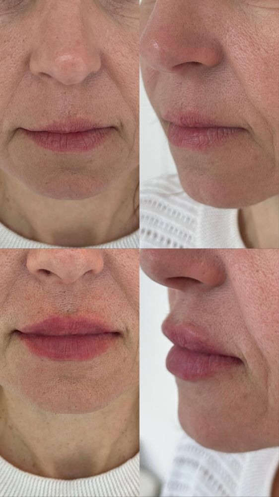 Акція збільшення губ , Botox