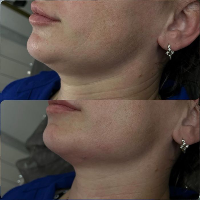 Ботокс.Увеличение губ.Гипергидроз