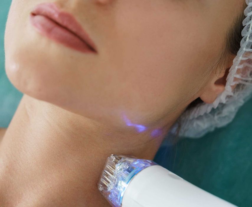 Wynajem urządzenia Radiofrekwencja mikroigłowa - RF frakcyjny