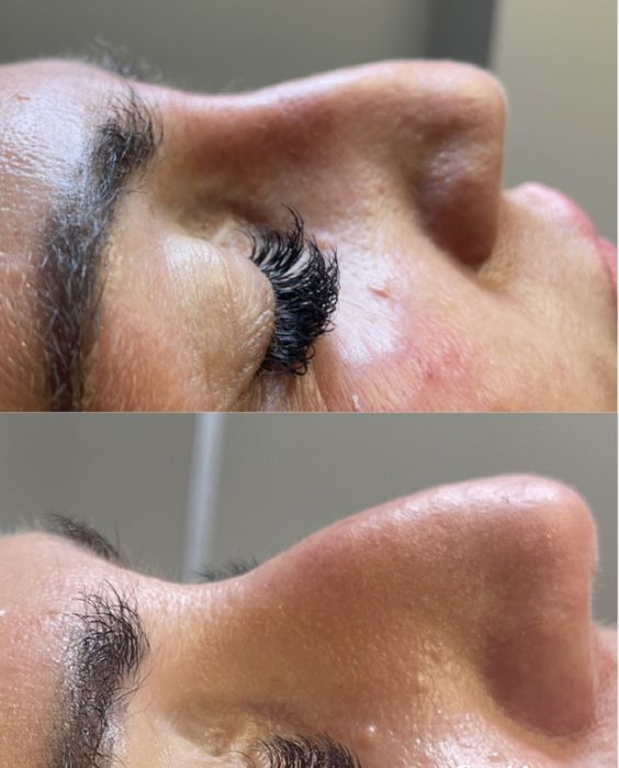 BTX , wygładzenie zmarszczek