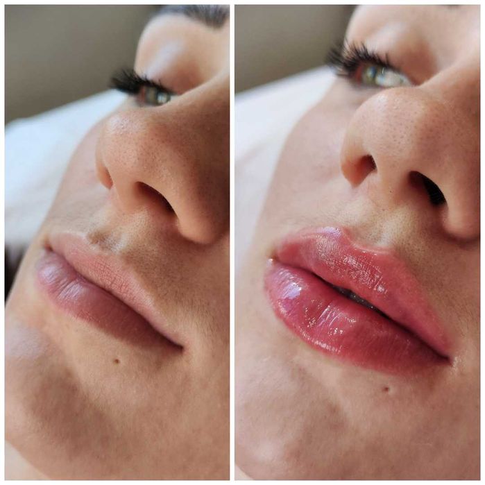 Увеличение губ, контурная коррекция