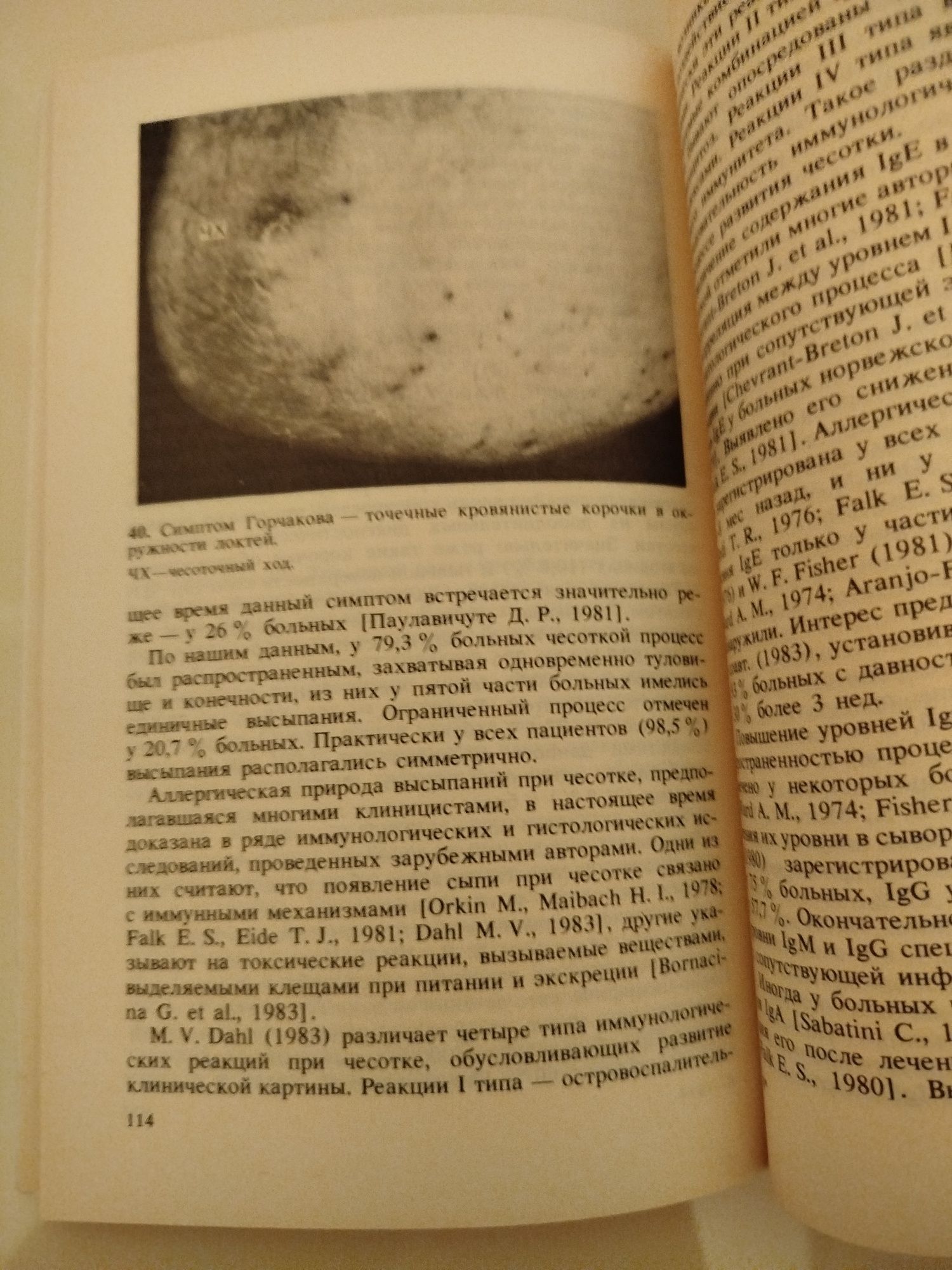 Чесотка. Т.В. Соколова, А. Б. Ланге