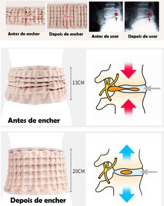 cinta insuflavel para coluna vertebral medula espinhal ciatica hernias