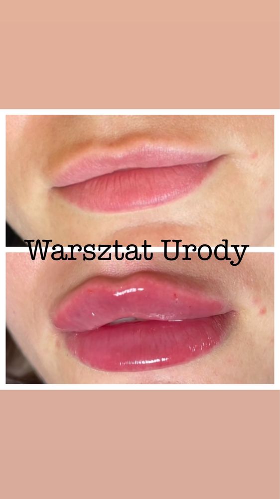 250zł= Botox - Botoks/ PLASMA IQ/ Wolumetria/ Powiększenie Ust - RATY